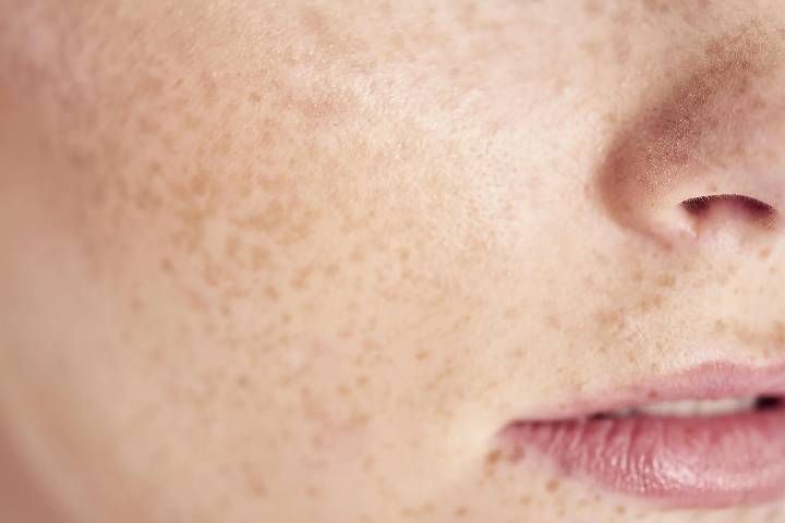 درمان لکه‌های پوستی ناشی از نور خورشید
