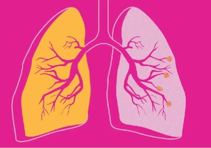 بیماری انسداد مزمن ریوی (COPD)